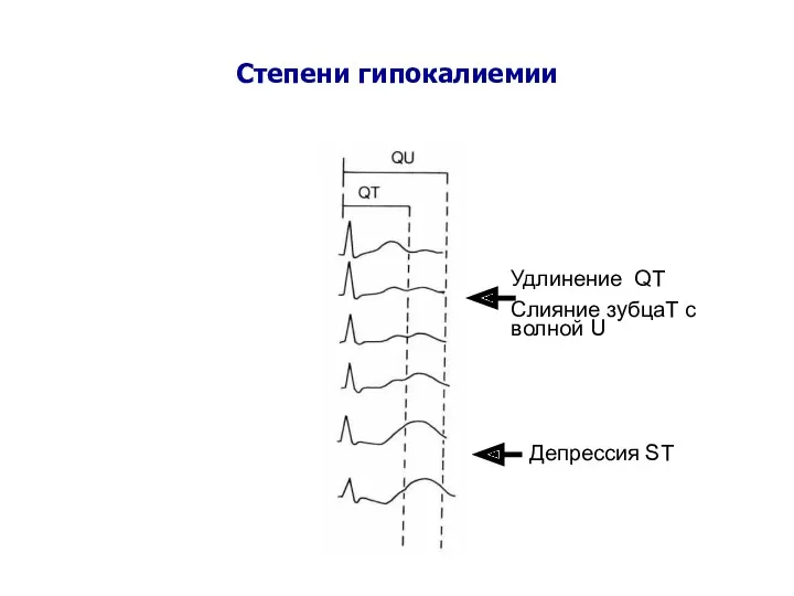 Степени гипокалиемии Удлинение QT Слияние зубцаT с волной U Депрессия ST