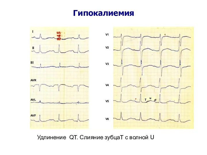 Гипокалиемия I II III AVR AVL AVF V1 V2 V3