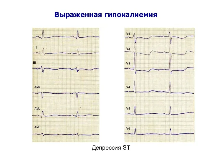 Выраженная гипокалиемия Депрессия ST I II III AVR AVL AVF V1 V2 V3 V4 V5 V6