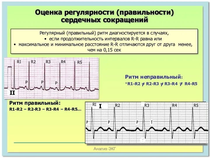 Анализ ЭКГ Оценка регулярности (правильности) сердечных сокращений Регулярный (правильный) ритм