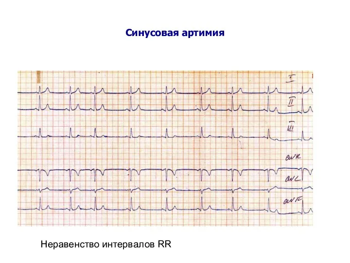 Синусовая артимия Неравенство интервалов RR