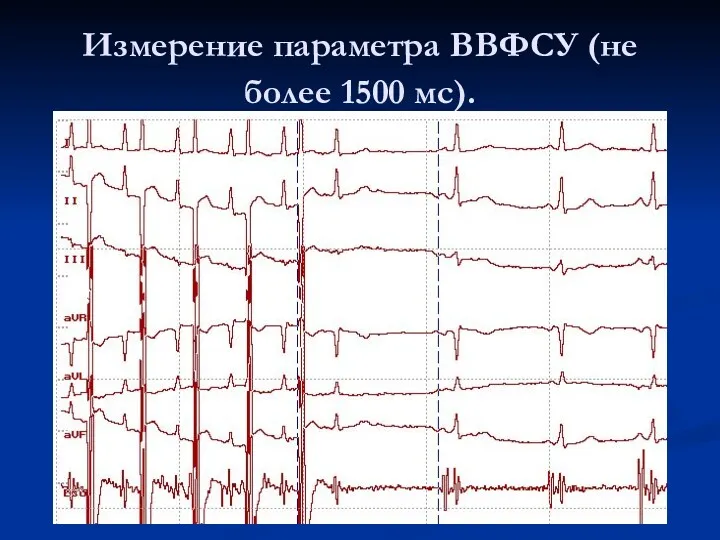 Измерение параметра ВВФСУ (не более 1500 мс).