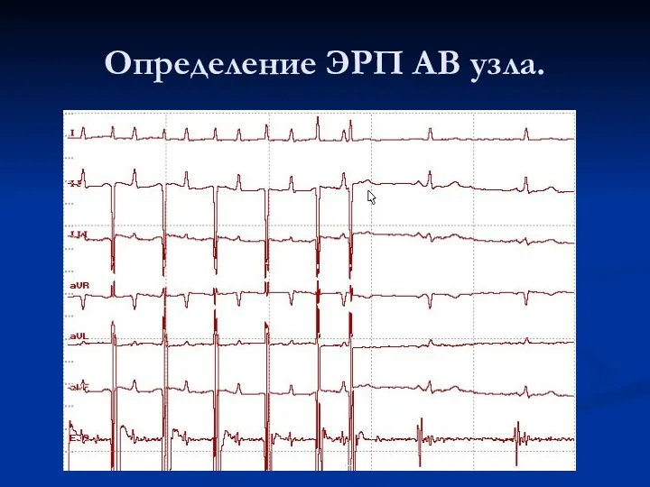 Определение ЭРП АВ узла.