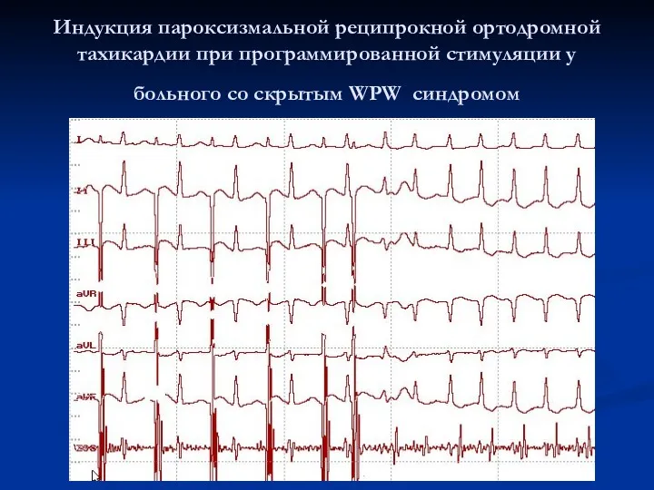 Индукция пароксизмальной реципрокной ортодромной тахикардии при программированной стимуляции у больного со скрытым WPW синдромом