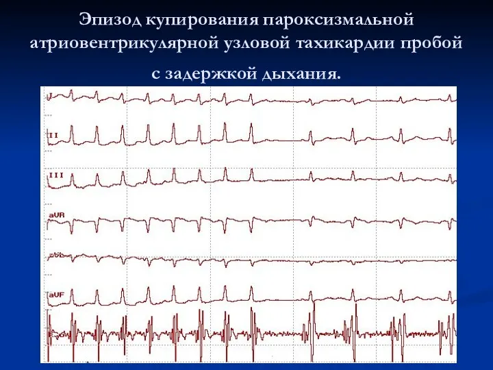 Эпизод купирования пароксизмальной атриовентрикулярной узловой тахикардии пробой с задержкой дыхания.