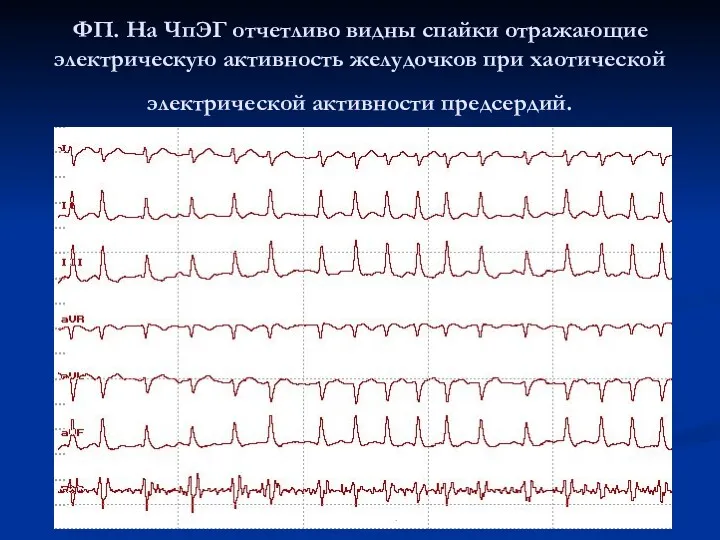 ФП. На ЧпЭГ отчетливо видны спайки отражающие электрическую активность желудочков при хаотической электрической активности предсердий.