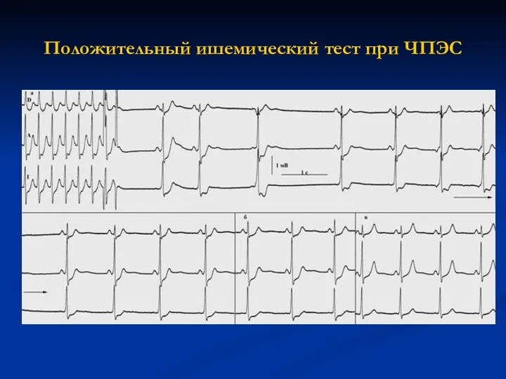 Положительный ишемический тест при ЧПЭС