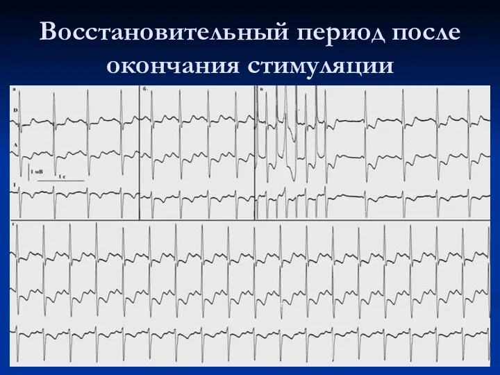 Восстановительный период после окончания стимуляции