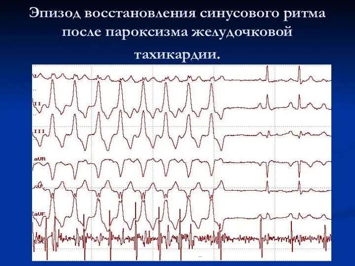 Эпизод восстановления синусового ритма после пароксизма желудочковой тахикардии.