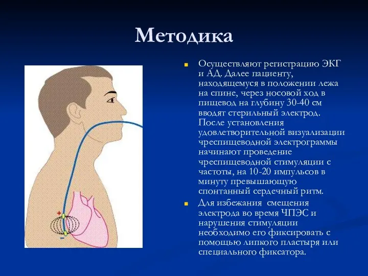 Методика Осуществляют регистрацию ЭКГ и АД. Далее пациенту, находящемуся в