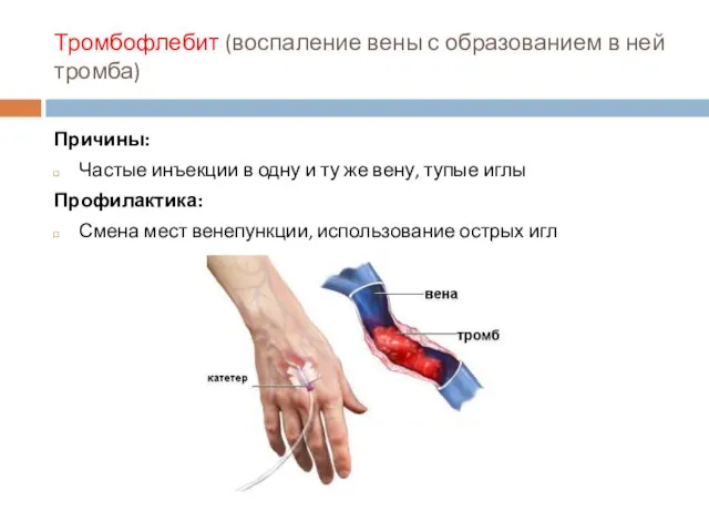 Тромбофлебит (воспаление вены с образованием в ней тромба) Причины: Частые