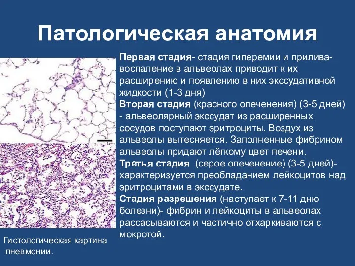 Патологическая анатомия Гистологическая картина пневмонии. Первая стадия- стадия гиперемии и