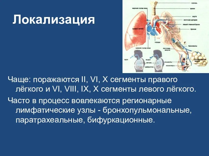 Локализация Чаще: поражаются II, VI, X сегменты правого лёгкого и