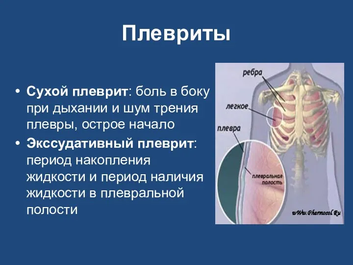 Плевриты Сухой плеврит: боль в боку при дыхании и шум