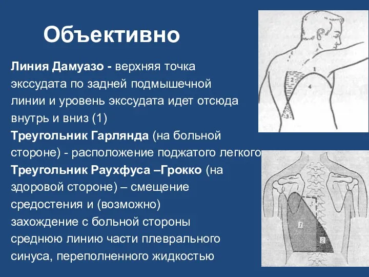 Объективно Линия Дамуазо - верхняя точка экссудата по задней подмышечной