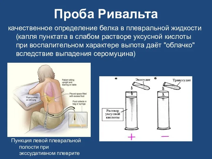 Проба Ривальта качественное определение белка в плевральной жидкости (капля пунктата