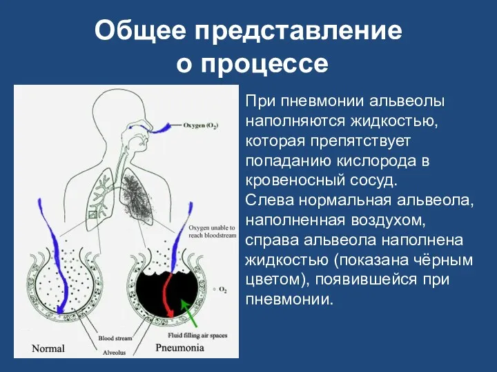 Общее представление о процессе При пневмонии альвеолы наполняются жидкостью, которая