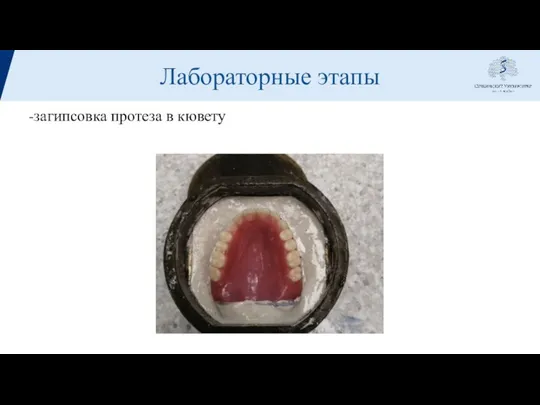 Лабораторные этапы -загипсовка протеза в кювету