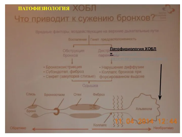 Патофизиология ХОБЛ = Обструкция + легочная гиперинфляция !!! ПАТОФИЗИОЛОГИЯ