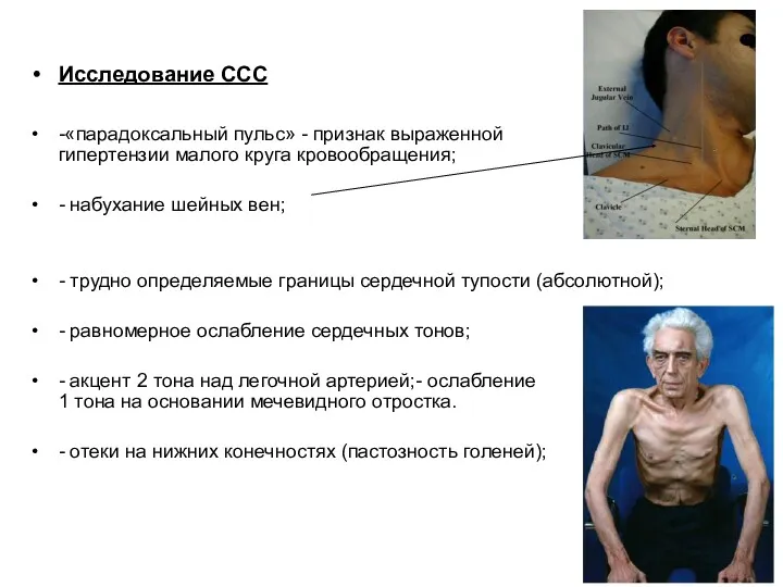 Исследование ССС -«парадоксальный пульс» - признак выраженной гипертензии малого круга