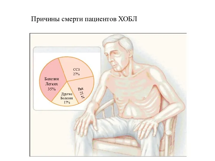 Болезни Легких 35% ССЗ 27% Рак 21% Другие Болезни 17% Причины смерти пациентов ХОБЛ