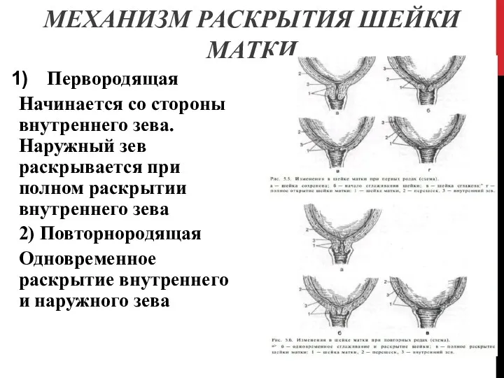 МЕХАНИЗМ РАСКРЫТИЯ ШЕЙКИ МАТКИ Первородящая Начинается со стороны внутреннего зева. Наружный зев раскрывается