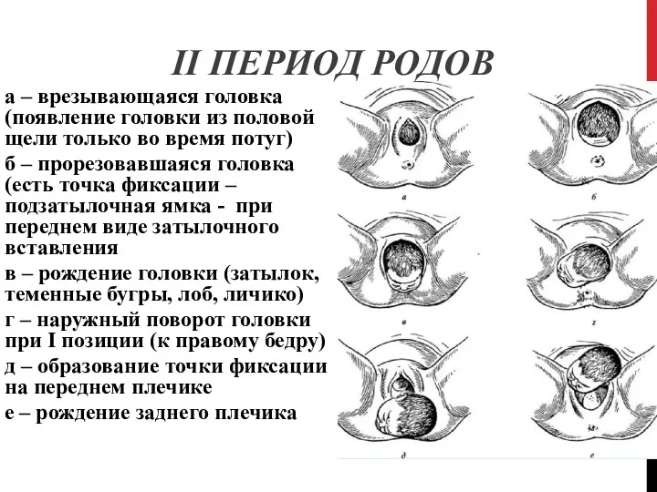 II ПЕРИОД РОДОВ а – врезывающаяся головка (появление головки из половой щели только