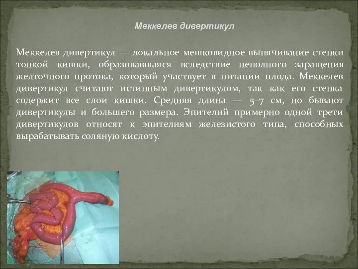 Меккелев дивертикул Меккелев дивертикул — локальное мешковидное выпячивание стенки тонкой