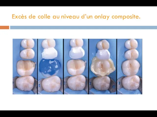 Excès de colle au niveau d’un onlay composite.