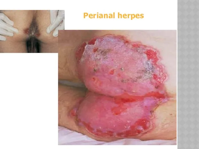 Perianal herpes