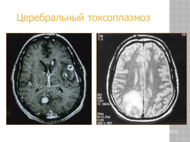 Из коллекции слайдов UCHSC AETC Церебральный токсоплазмоз