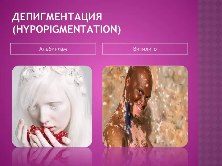 ДЕПИГМЕНТАЦИЯ (HYPOPIGMENTATION) Альбинизм Витилиго