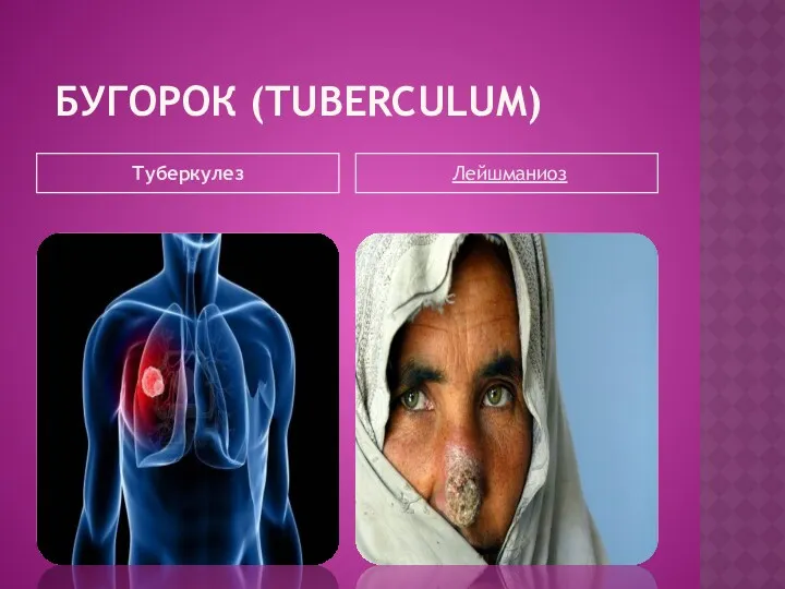 БУГОРОК (TUBERCULUM) Туберкулез Лейшманиоз