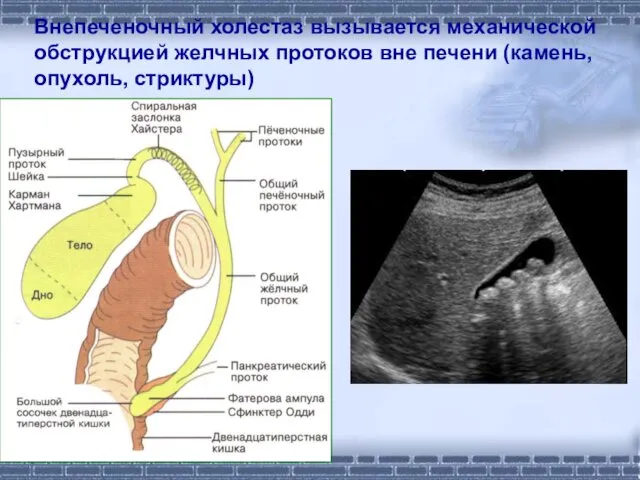 Внепеченочный холестаз вызывается механической обструкцией желчных протоков вне печени (камень, опухоль, стриктуры)