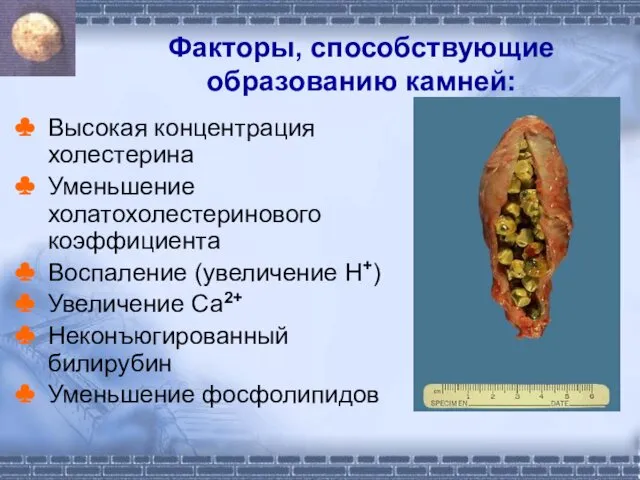 Факторы, способствующие образованию камней: Высокая концентрация холестерина Уменьшение холатохолестеринового коэффициента