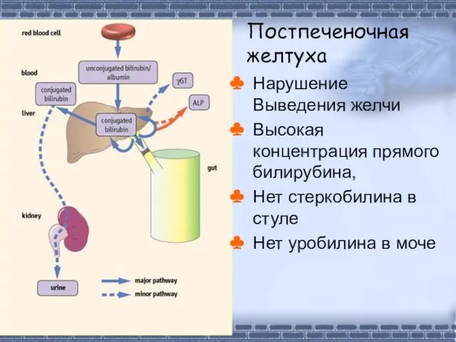 Постпеченочная желтуха Нарушение Выведения желчи Высокая концентрация прямого билирубина, Нет стеркобилина в стуле