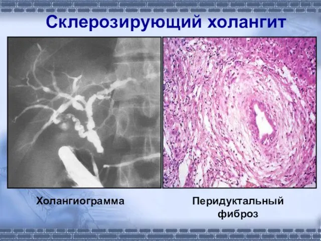 Склерозирующий холангит Холангиограмма Перидуктальный фиброз