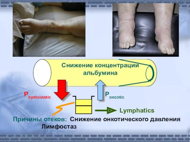 Снижение концентрации альбумина Причины отеков: Снижение онкотического давления Лимфостаз