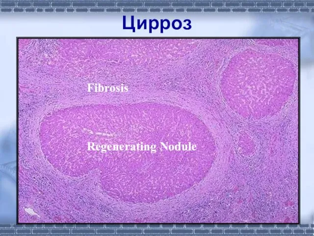 Цирроз Fibrosis Regenerating Nodule