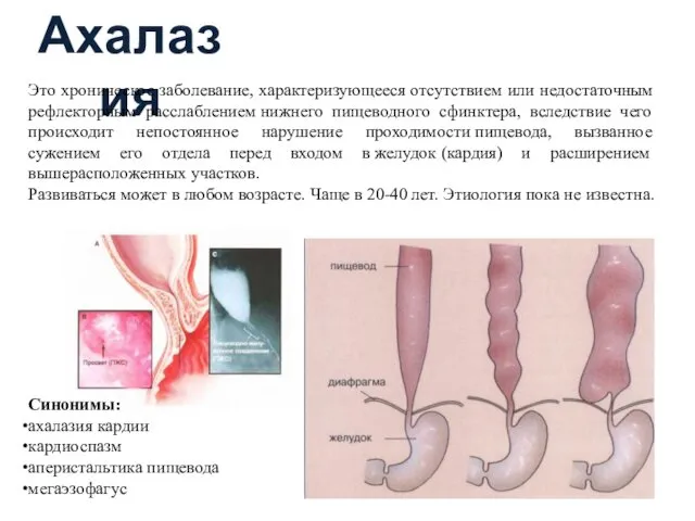 Ахалазия Это хроническое заболевание, характеризующееся отсутствием или недостаточным рефлекторным расслаблением