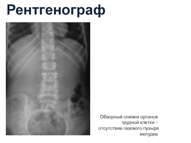 Рентгенография Обзорный снимок органов грудной клетки – отсутствие газового пузыря желудка