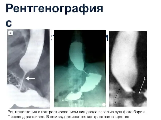 Рентгенография с контрастированием Рентгеноскопия с контрастированием пищевода взвесью сульфата бария.