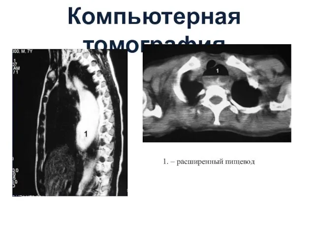 Компьютерная томография 1. – расширенный пищевод