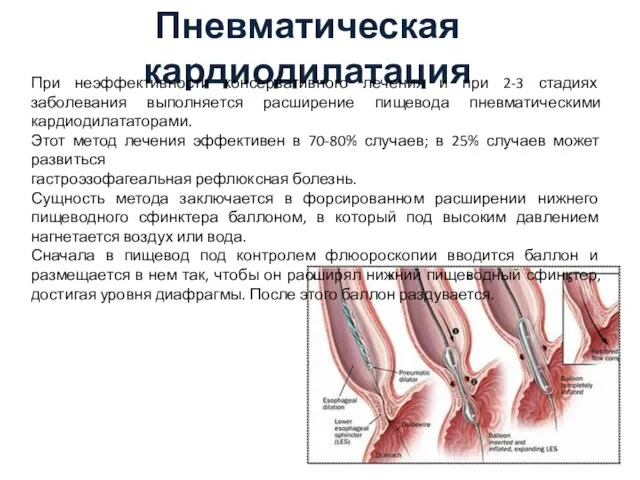 Пневматическая кардиодилатация При неэффективности консервативного лечения и при 2-3 стадиях заболевания выполняется расширение