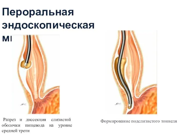 Пероральная эндоскопическая миотомия Разрез и диссекция слизистой оболочки пищевода на уровне средней трети Формирование подслизистого тоннеля