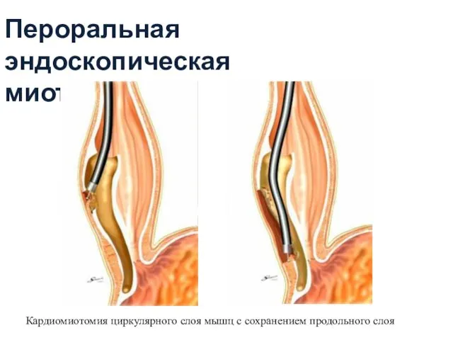 Пероральная эндоскопическая миотомия Кардиомиотомия циркулярного слоя мышц с сохранением продольного слоя