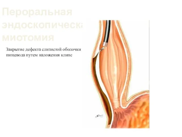 Пероральная эндоскопическая миотомия Закрытие дефекта слизистой оболочки пищевода путем наложения клипс