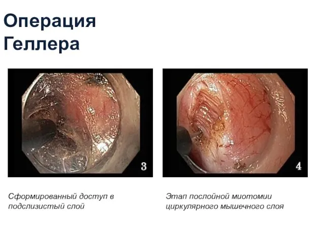 Операция Геллера Сформированный доступ в подслизистый слой Этап послойной миотомии циркулярного мышечного слоя