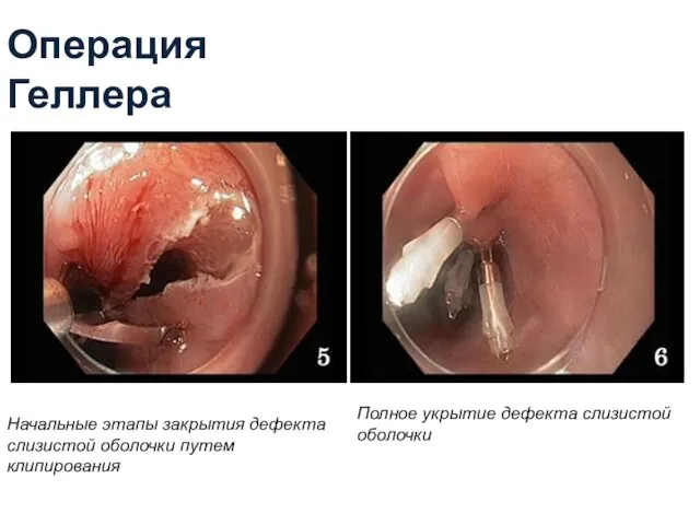 Операция Геллера Начальные этапы закрытия дефекта слизистой оболочки путем клипирования Полное укрытие дефекта слизистой оболочки