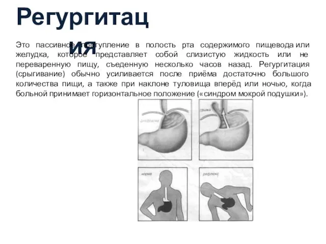 Регургитация Это пассивное поступление в полость рта содержимого пищевода или